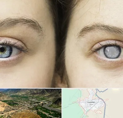 متخصص آب سیاه (گلوکوم) در اسدآباد
