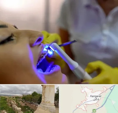 دندانپزشکی با لیزر در کنگاور