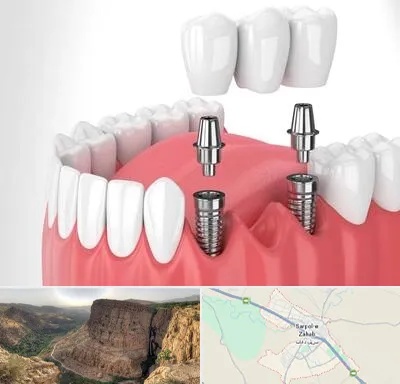 کاشت دندان در سرپل ذهاب