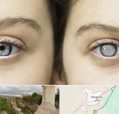 متخصص آب سیاه (گلوکوم) در کنگاور