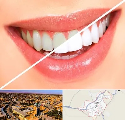 بلیچینگ دندان در بافق