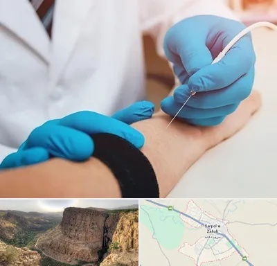 مرکز نوار عصب و عضله در سرپل ذهاب