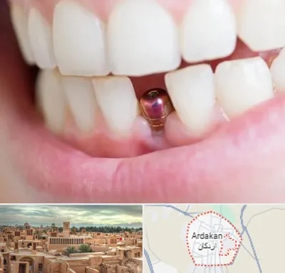 ایمپلنت اقساطی در اردکان