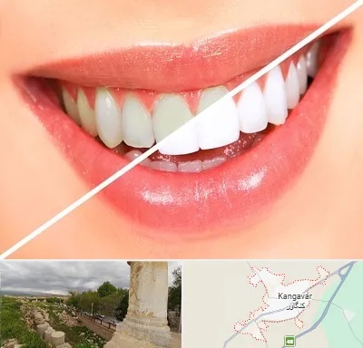 بلیچینگ دندان در کنگاور