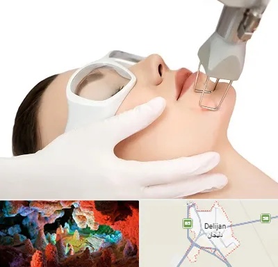 لیزر فرکشنال در دلیجان