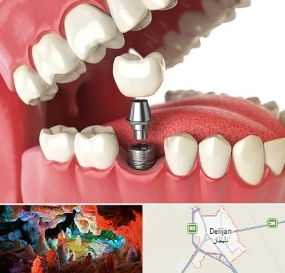 متخصص پروتز دندان در دلیجان