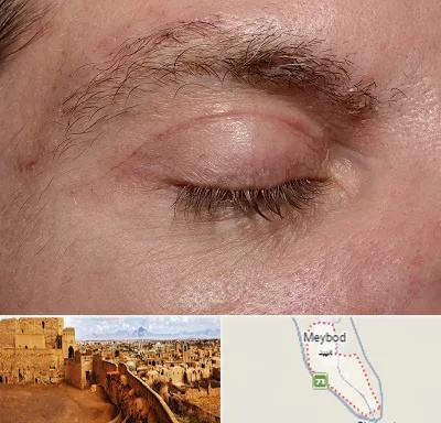 جراح بلفاروپلاستی در میبد