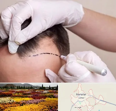 کاشت مو به روش SUT در محلات