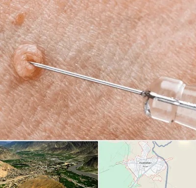 لیزر زگیل تناسلی در اسدآباد