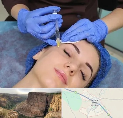 تزریق پروفایلو در سرپل ذهاب