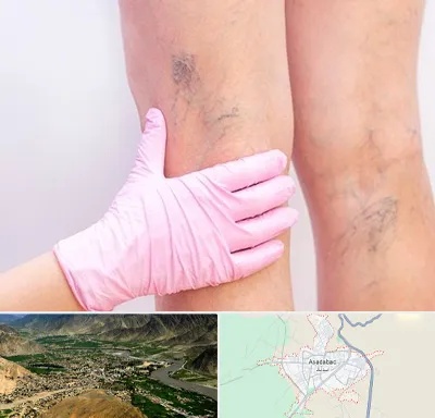 دکتر فوق تخصص واریس در اسدآباد