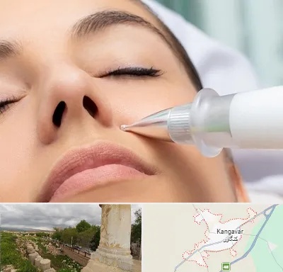 پلاسما جت بینی در کنگاور