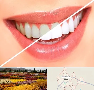 بلیچینگ دندان در محلات