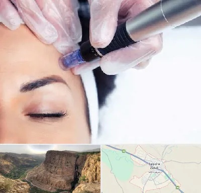 کلینیک مزوتراپی صورت در سرپل ذهاب