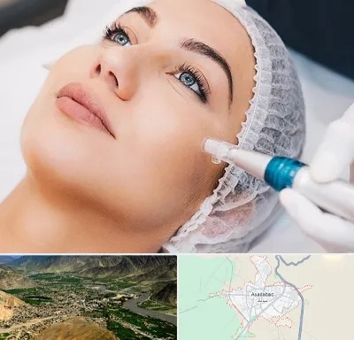 مزونیدلینگ در اسدآباد