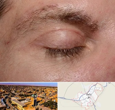 جراح بلفاروپلاستی در بافق