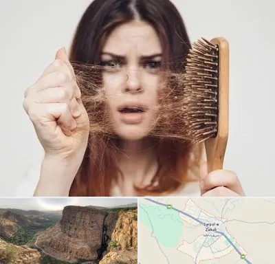 دکتر ریزش مو در سرپل ذهاب