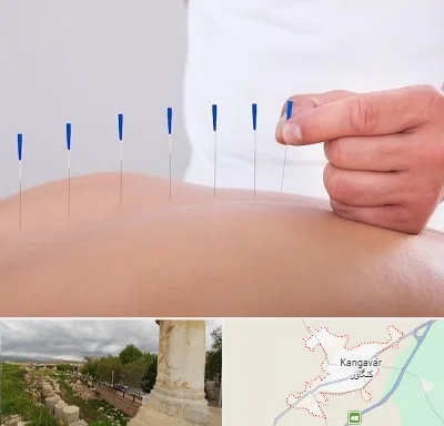 دکتر طب سوزنی در کنگاور
