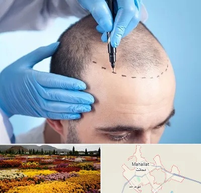 دکتر کاشت مو در محلات
