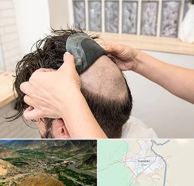 پروتز مو در اسدآباد