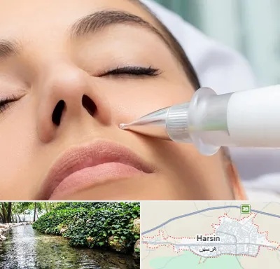 پلاسما جت بینی در هرسین