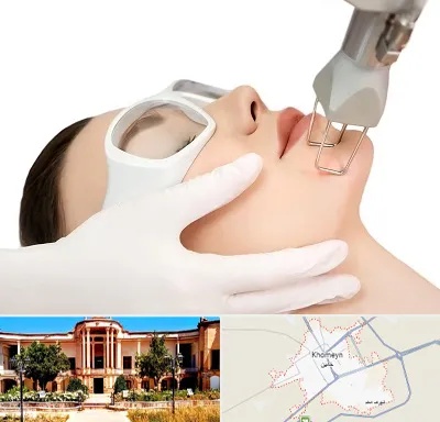 لیزر فرکشنال در خمین