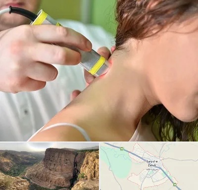 لیزر درمانی در سرپل ذهاب