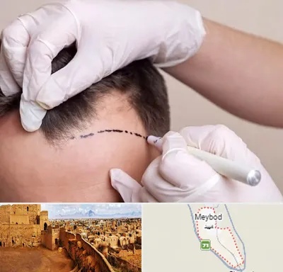 کاشت مو به روش SUT در میبد