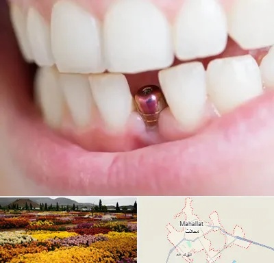 ایمپلنت اقساطی در محلات