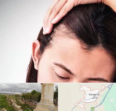 کاشت مو بانوان در کنگاور