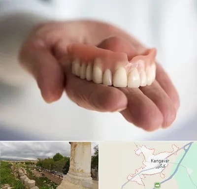 لیفت لثه با لیزر در کنگاور