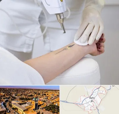 پاک کردن تتو با لیزر در بافق