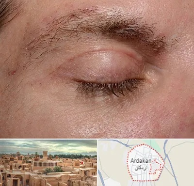 جراح بلفاروپلاستی در اردکان