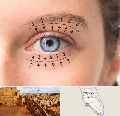 عمل افتادگی پلک در میبد