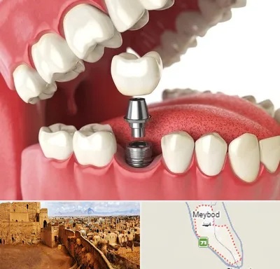 متخصص پروتز دندان در میبد