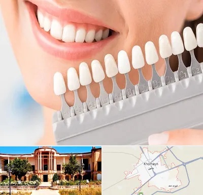 متخصص لمینت دندان در خمین