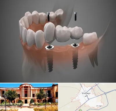 ایمپلنت دیجیتال در خمین