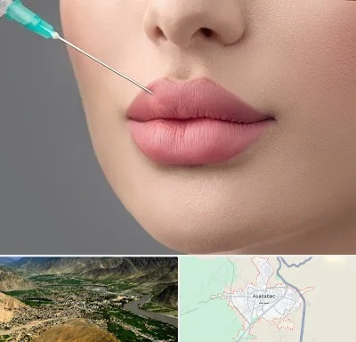کلینیک ژل لب روسی در اسدآباد