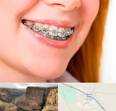 ارتودنسی ارزان در سرپل ذهاب
