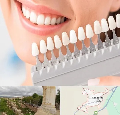 متخصص لمینت دندان در کنگاور