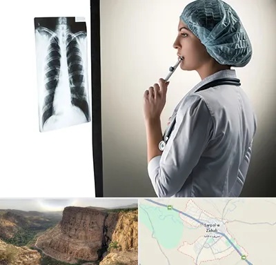 دکتر سرطان ریه در سرپل ذهاب
