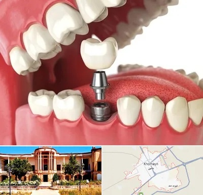 متخصص پروتز دندان در خمین
