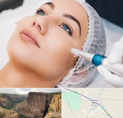 مزونیدلینگ در سرپل ذهاب
