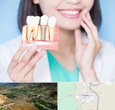 متخصص ایمپلنت در اسدآباد