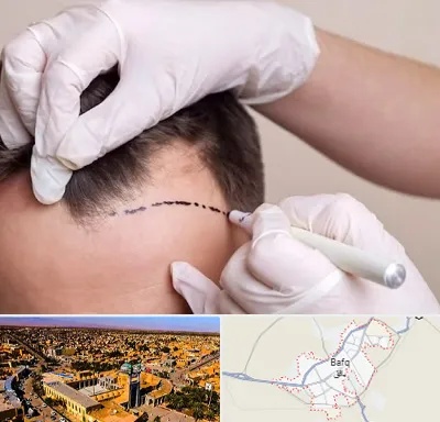 کاشت مو به روش SUT در بافق