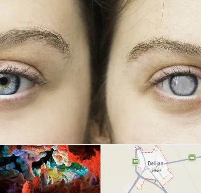 متخصص آب سیاه (گلوکوم) در دلیجان