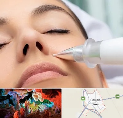پلاسما جت بینی در دلیجان