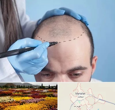 کاشت مو اقساطی در محلات