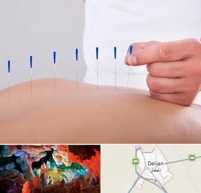 دکتر طب سوزنی در دلیجان