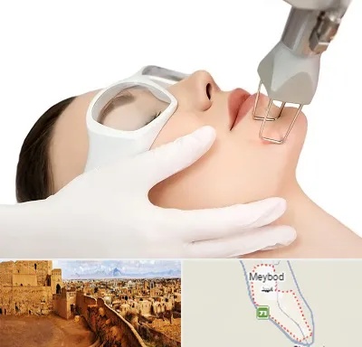 لیزر فرکشنال در میبد
